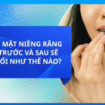 KHUÔN MẶT NIỀNG RĂNG MÓM TRƯỚC VÀ SAU SẼ THAY ĐỔI NHƯ THẾ NÀO?