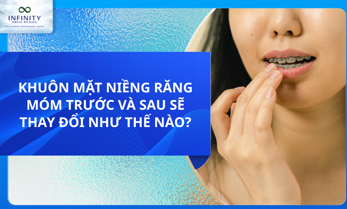 KHUÔN MẶT NIỀNG RĂNG MÓM TRƯỚC VÀ SAU SẼ THAY ĐỔI NHƯ THẾ NÀO?