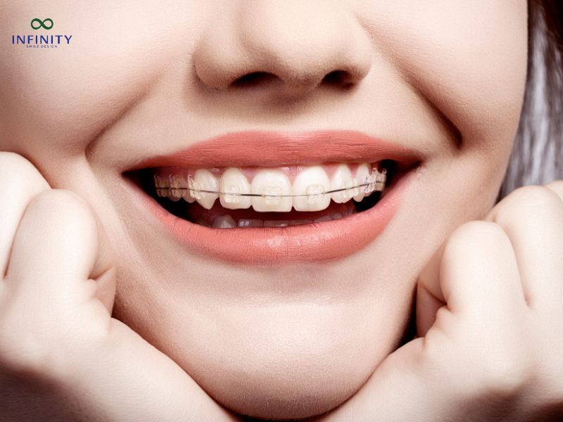 Dấu hiệu bình thường khi mới niềng răng