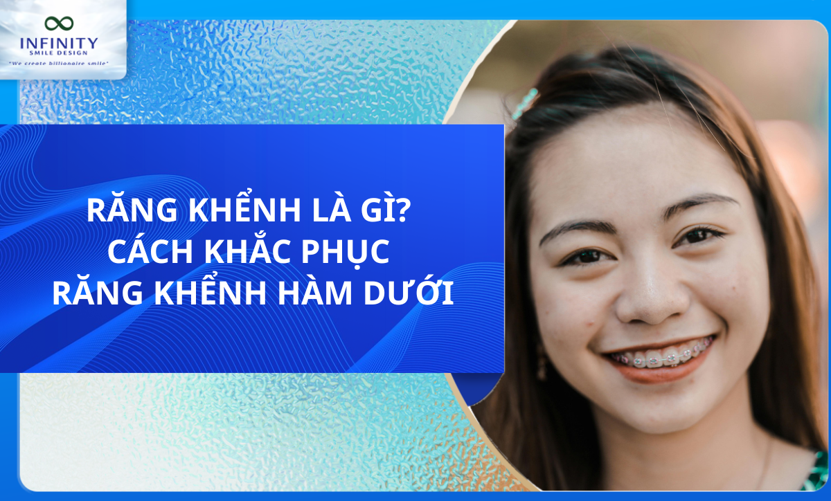 RĂNG KHỂNH LÀ GÌ? CÁCH KHẮC PHỤC RĂNG KHỂNH HÀM DƯỚI