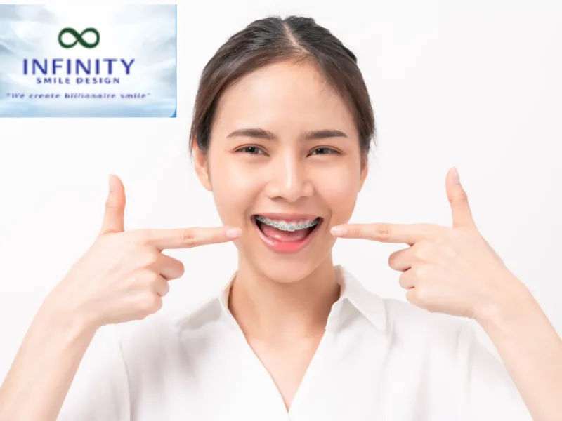 Niềng Răng Mắc Cài Cánh Cam – Giải Pháp Chỉnh Nha Hiệu Quả 3 Người lớn thường có lịch trình bận rộn, ít thời gian tái khám. Nhờ đặc điểm giảm số lần điều chỉnh, mắc cài cánh cam trở thành giải pháp lý tưởng cho họ.