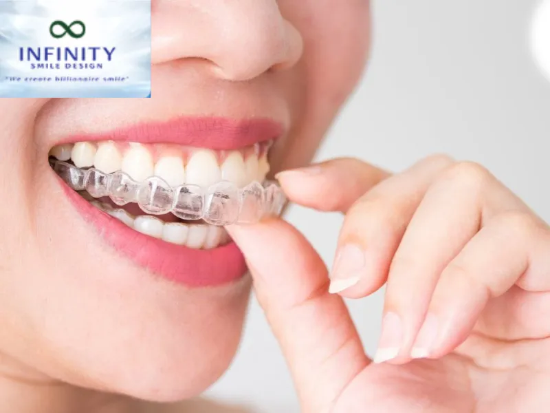Niềng Răng Bằng Nhựa: Lựa Chọn Cho Nụ Cười Hoàn Hảo 4 Để đạt được hiệu quả tốt nhất từ niềng răng bằng nhựa, bạn cần duy trì thói quen vệ sinh răng miệng cẩn thận.