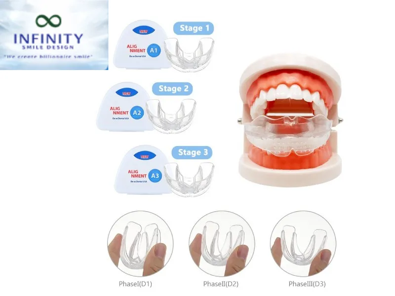 Niềng răng trainer có thể tháo lắp dễ dàng, giúp bạn thoải mái trong việc ăn uống và vệ sinh răng miệng.
