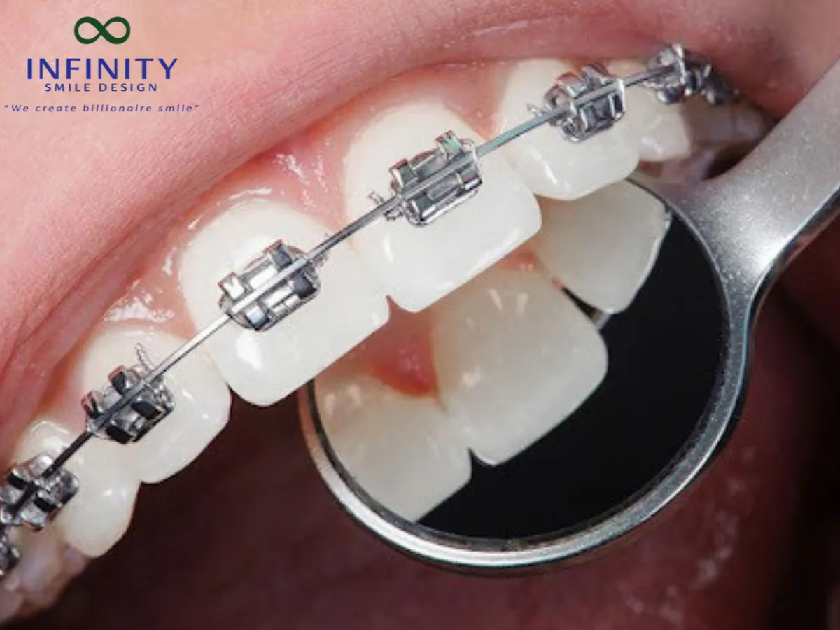 Việc chọn đúng kích thước chỉ thép giúp kiểm soát lực kéo tốt hơn, tránh gây tổn thương cho răng và mô mềm.