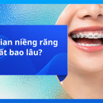 Thời gian niềng răng mất bao lâu?