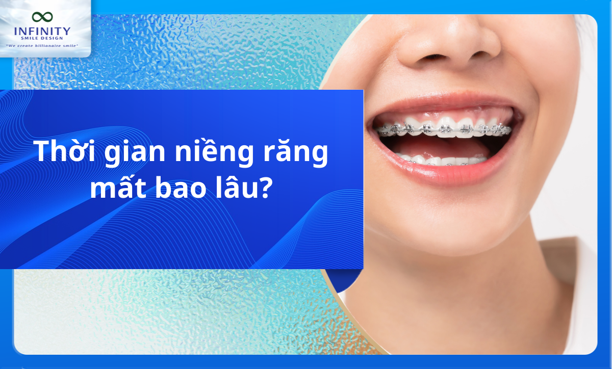 Thời gian niềng răng mất bao lâu?