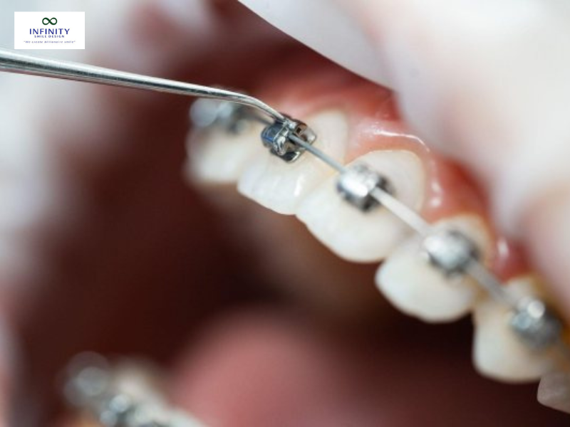 Bác sĩ sẽ kiểm tra lại vị trí vít và nướu xung quanh