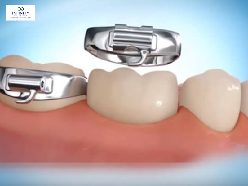 Sử dụng dụng cụ chuyên dụng để ấn nhẹ nhàng chiếc band vào vị trí Sử dụng dụng cụ chuyên dụng để ấn nhẹ nhàng chiếc band vào vị trí