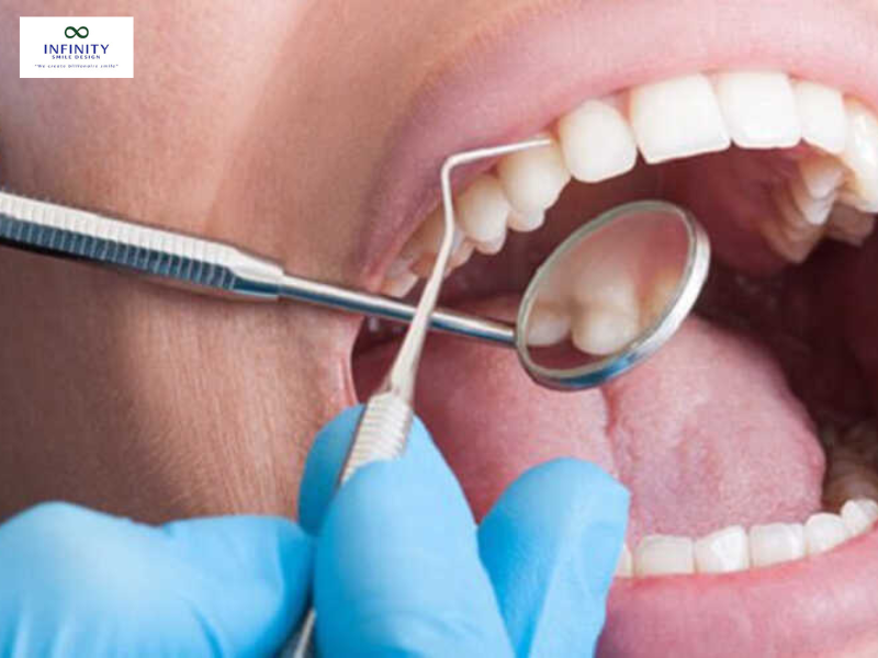 Đây là phương pháp niềng răng không gắn band và cũng không gắn mắc cài theo nghĩa truyền thống