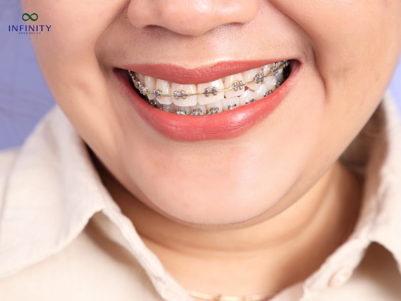 Một số phương pháp niềng có thể phù hợp hơn cho những răng yếu
