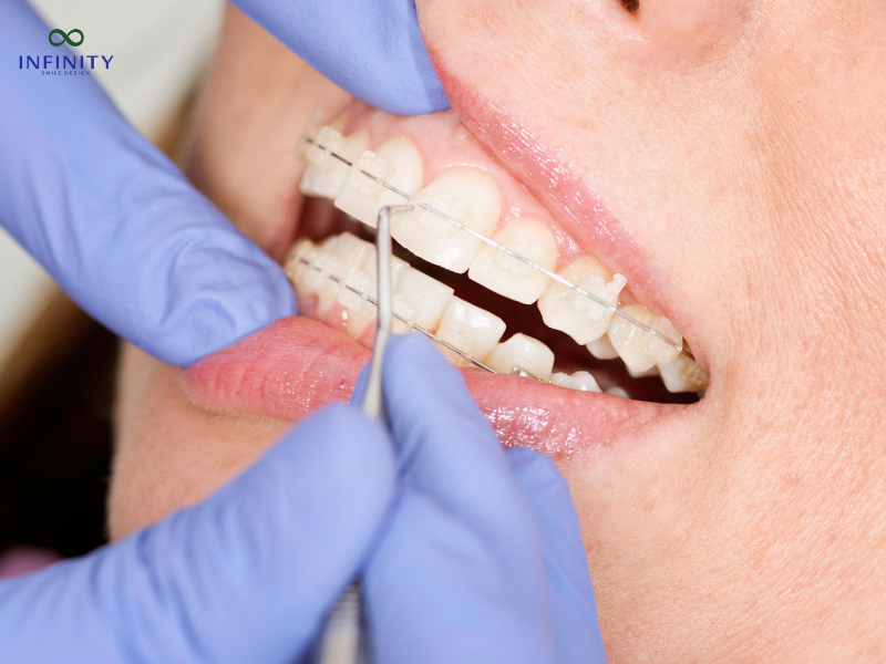 Lợi Ích Của Niềng Răng Lợi Ích Của Niềng Răng