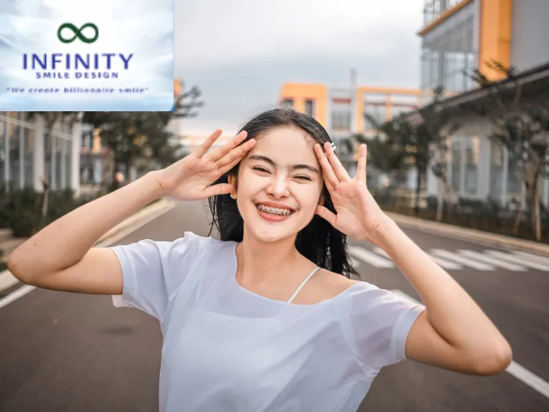 Niềng Răng Mắc Cài Cánh Cam – Giải Pháp Chỉnh Nha Hiệu Quả 4 Sau khi đạt được sự dịch chuyển như mong muốn, bác sĩ sẽ tháo niềng và hướng dẫn đeo hàm duy trì để ổn định kết quả lâu dài.
