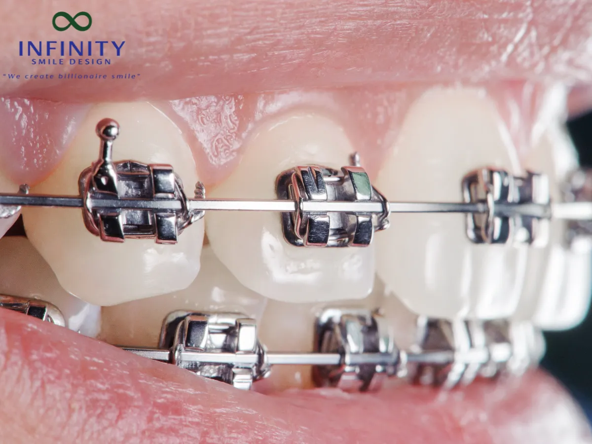 Chỉ thép có thể chịu được lực kéo lớn mà không bị đứt hay biến dạng.