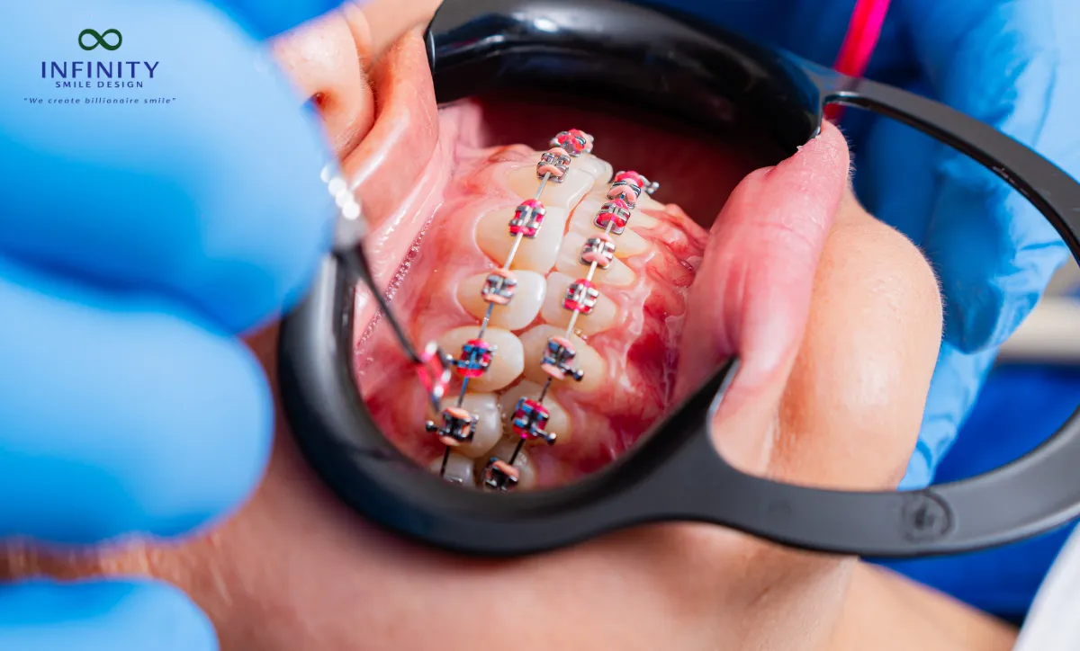 Giải Mã Hiện Tượng Bung Mắc Cài Trong Quá Trình Niềng Răng 5 Việc tái khám định kỳ giúp bác sĩ kiểm tra tình trạng mắc cài, dây cung và điều chỉnh kịp thời để tránh bung mắc cài.