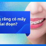 Niềng răng có mấy giai đoạn?