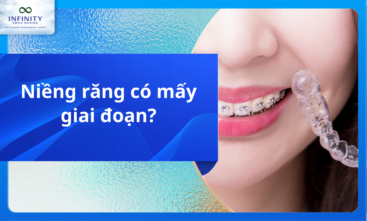 Niềng răng có mấy giai đoạn?