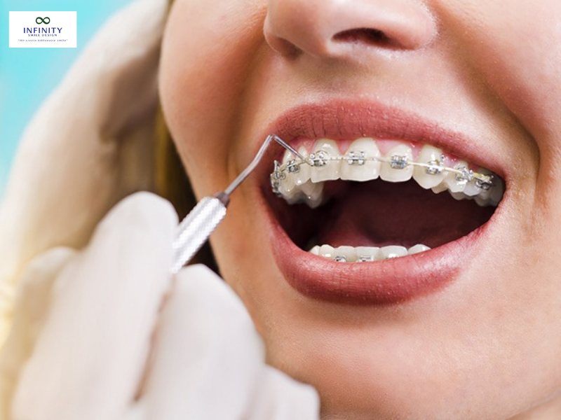 cắm vít niềng răng bị sưng