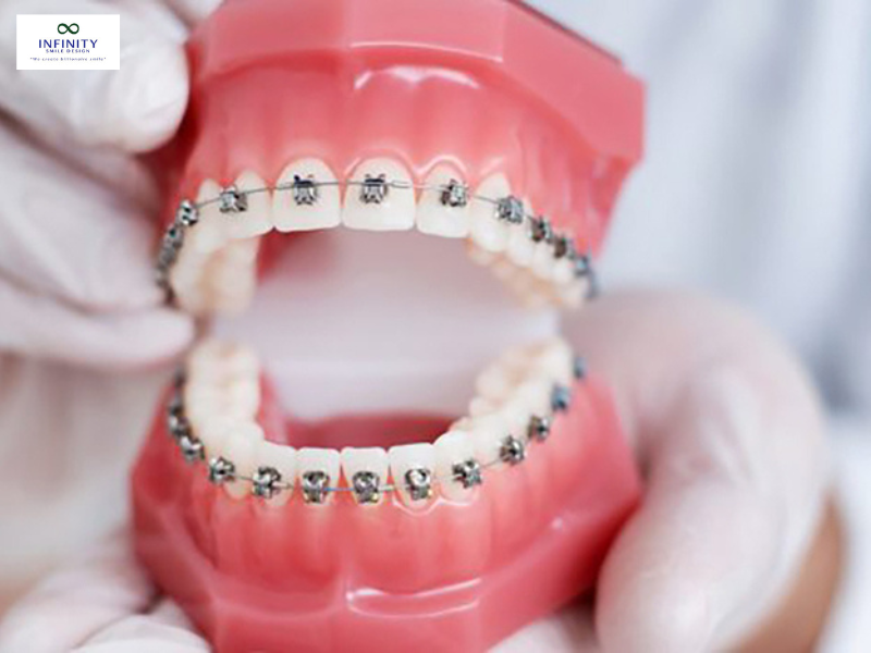 Gắn band răng là một phần của kế hoạch chỉnh nha tổng thể Gắn band răng là một phần của kế hoạch chỉnh nha tổng thể