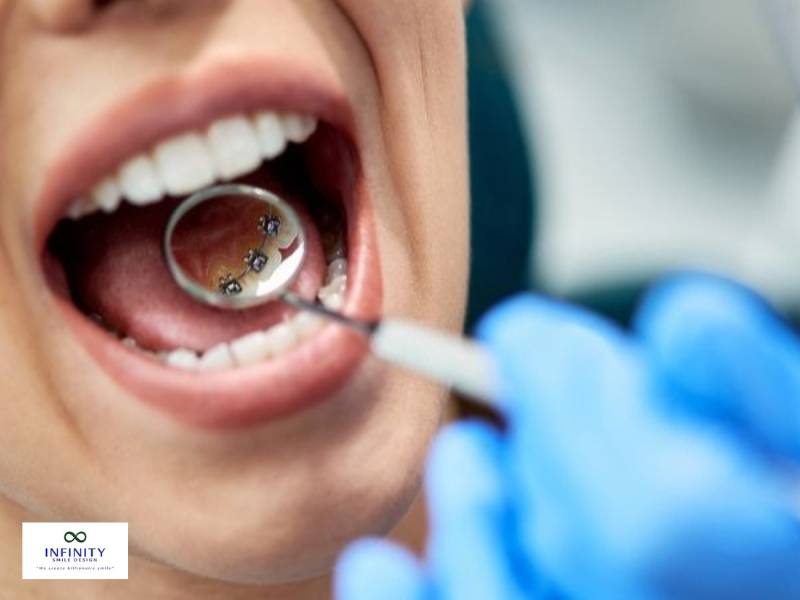Quy trình đặt band vào mỗi răng diễn ra rất nhanh chóng