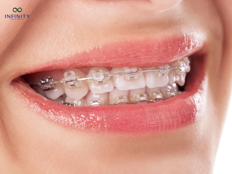 Niềng răng là phương pháp chỉnh nha sử dụng hệ thống mắc cài hoặc khay trong suốt để dịch chuyển răng về vị trí mong muốn