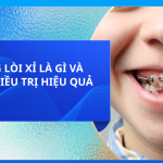RĂNG LÒI XỈ LÀ GÌ VÀ CÁCH ĐIỀU TRỊ HIỆU QUẢ