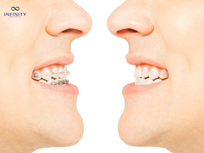 3 cách chăm sóc răng sau niềng răng hiệu quả 3 cách chăm sóc răng sau niềng răng hiệu quả