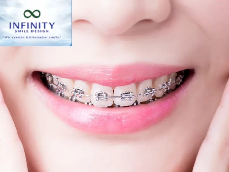 Niềng Răng Mắc Cài Cánh Cam – Giải Pháp Chỉnh Nha Hiệu Quả 2 Không phải ngẫu nhiên mà niềng răng mắc cài cánh cam được nhiều người lựa chọn