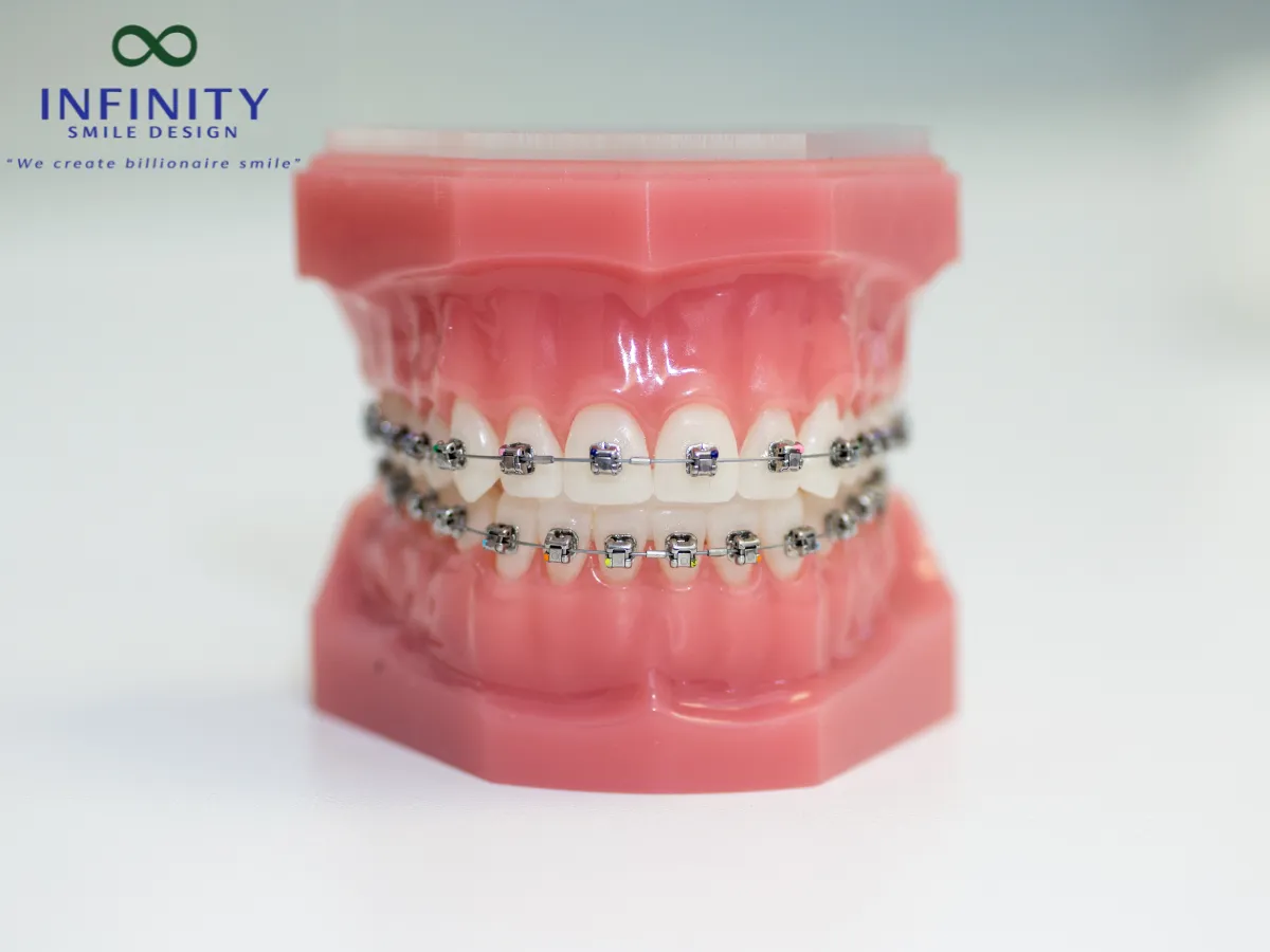 Chỉ thép buộc mắc cài là một dây thép nhỏ, có độ dẻo vừa phải, làm từ thép không gỉ hoặc hợp kim đặc biệt