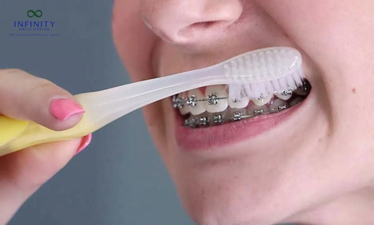 Giải Mã Hiện Tượng Bung Mắc Cài Trong Quá Trình Niềng Răng 3 Việc dùng lực chải răng quá mạnh hoặc dùng bàn chải không phù hợp cũng có thể làm lỏng mắc cài.