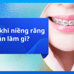 Trước khi niềng răng cần làm gì?