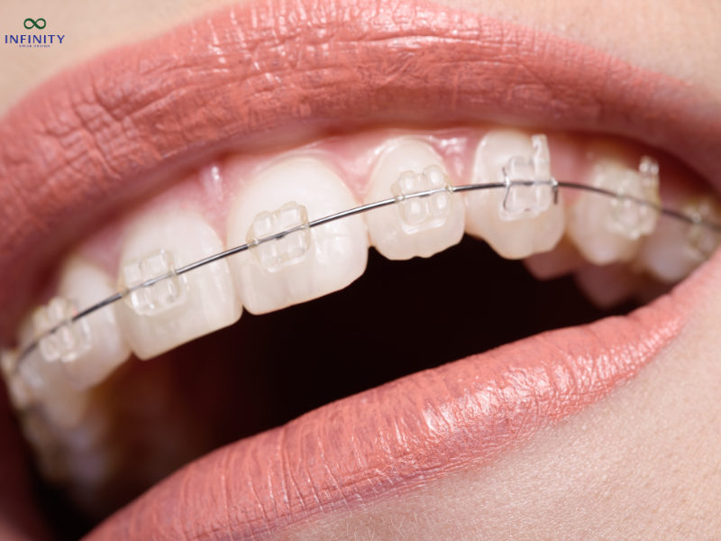 Cảm giác khi mới niềng răng ra sao? Cảm giác khi mới niềng răng ra sao?