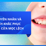 NGUYÊN NHÂN VÀ CÁCH KHẮC PHỤC RĂNG CỬA MỌC LỆCH 