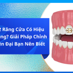 Niềng 2 răng cửa có hiệu quả không? Giải pháp chỉnh nha hiện đại bạn nên biết