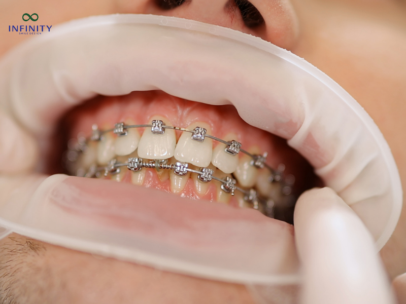  Điều chỉnh mắc cài hoặc khay niềng