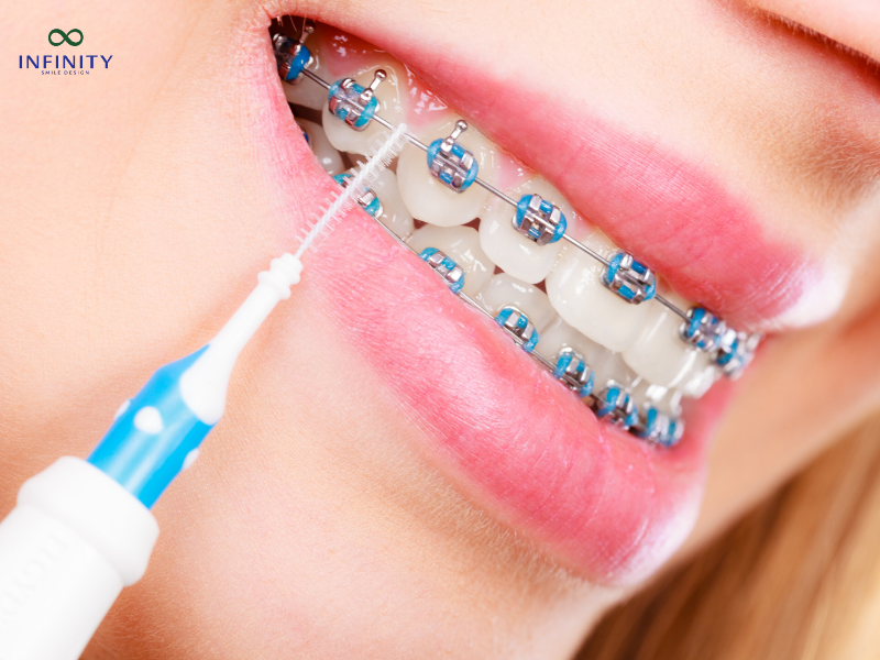 5 cách giảm đau răng khi niềng hiệu quả nhất 5 cách giảm đau răng khi niềng hiệu quả nhất