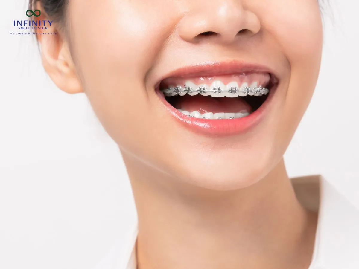 Hiện tượng răng chạy lại sau khi tháo niềng là gì?