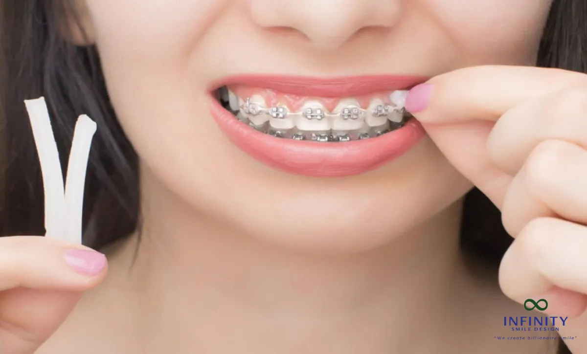 Giải Mã Hiện Tượng Bung Mắc Cài Trong Quá Trình Niềng Răng 4 Nếu mắc cài vẫn còn dính dây cung nhưng bị bung, bạn nên sử dụng sáp chỉnh nha chuyên dụng để cố định mắc cài.