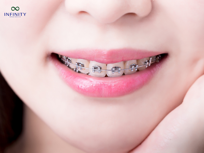 5 cách giảm đau răng khi niềng hiệu quả nhất 5 cách giảm đau răng khi niềng hiệu quả nhất