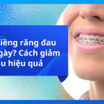 Mới niềng răng đau mấy ngày? Cách giảm đau hiệu quả