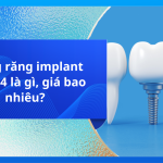Trồng răng implant all on 4 là gì, giá bao nhiêu?