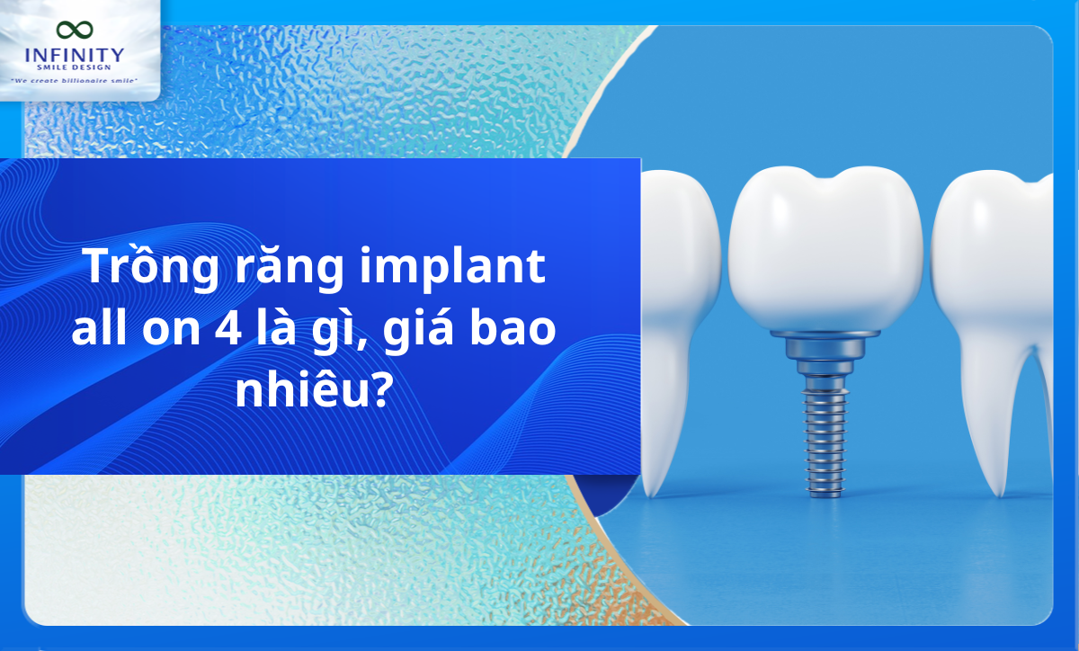 Trồng răng implant all on 4 là gì, giá bao nhiêu?