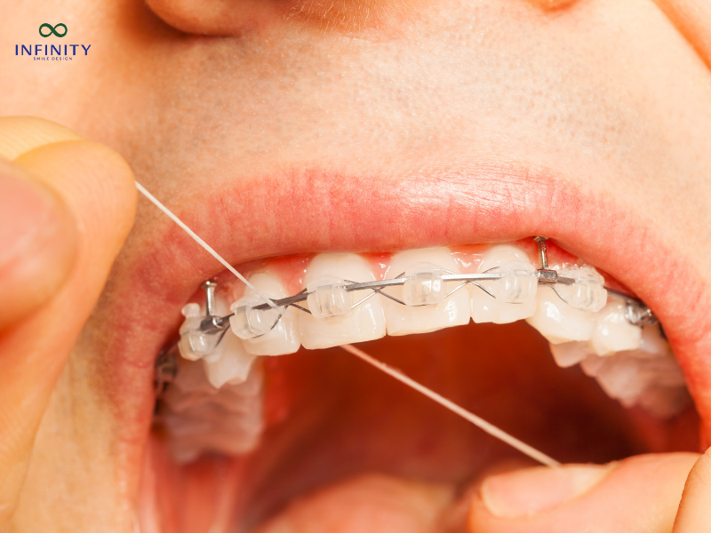 Vệ sinh răng miệng hằng ngày đúng cách