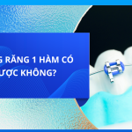 NIỀNG RĂNG 1 HÀM CÓ ĐƯỢC KHÔNG?