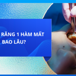 NIỀNG RĂNG 1 HÀM MẤT BAO LÂU?