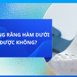 CHỈ NIỀNG RĂNG HÀM DƯỚI CÓ ĐƯỢC KHÔNG?