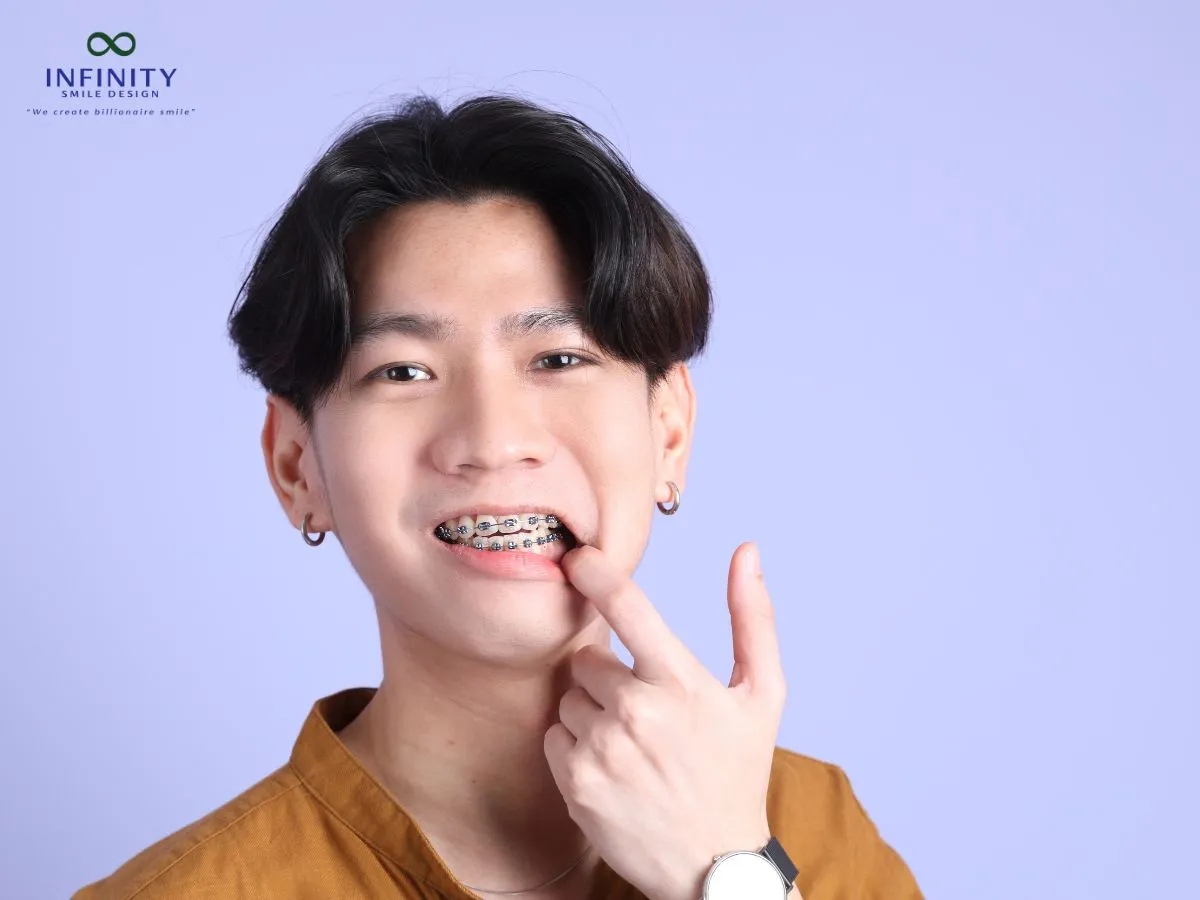 Lời khuyên cho người niềng răng để duy trì dây thun trắng sáng