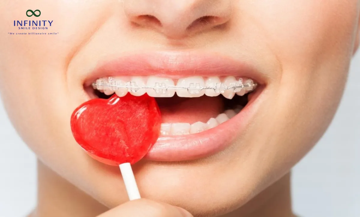 Giải Mã Hiện Tượng Bung Mắc Cài Trong Quá Trình Niềng Răng 2 Các loại thực phẩm cứng như kẹo cứng, hạt hướng dương, hạt dẻ hay các món dai như thịt khô, mực nướng… rất dễ gây áp lực lớn lên mắc cài
