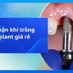 Hối hận khi trồng implant giá rẻ