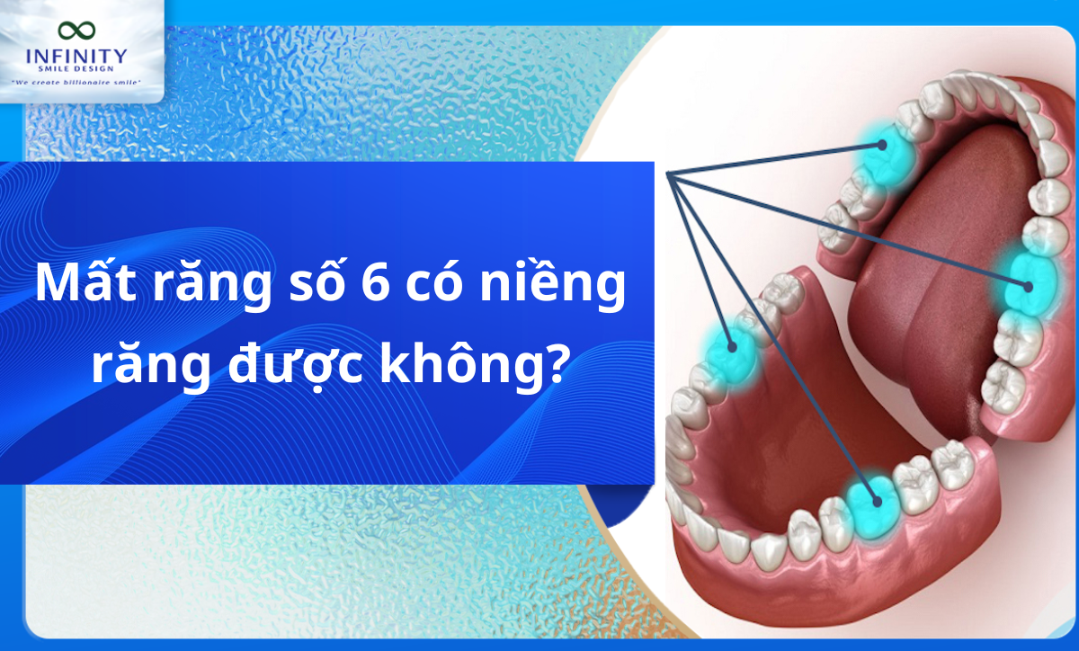 Mất răng số 6 có niềng răng được không?