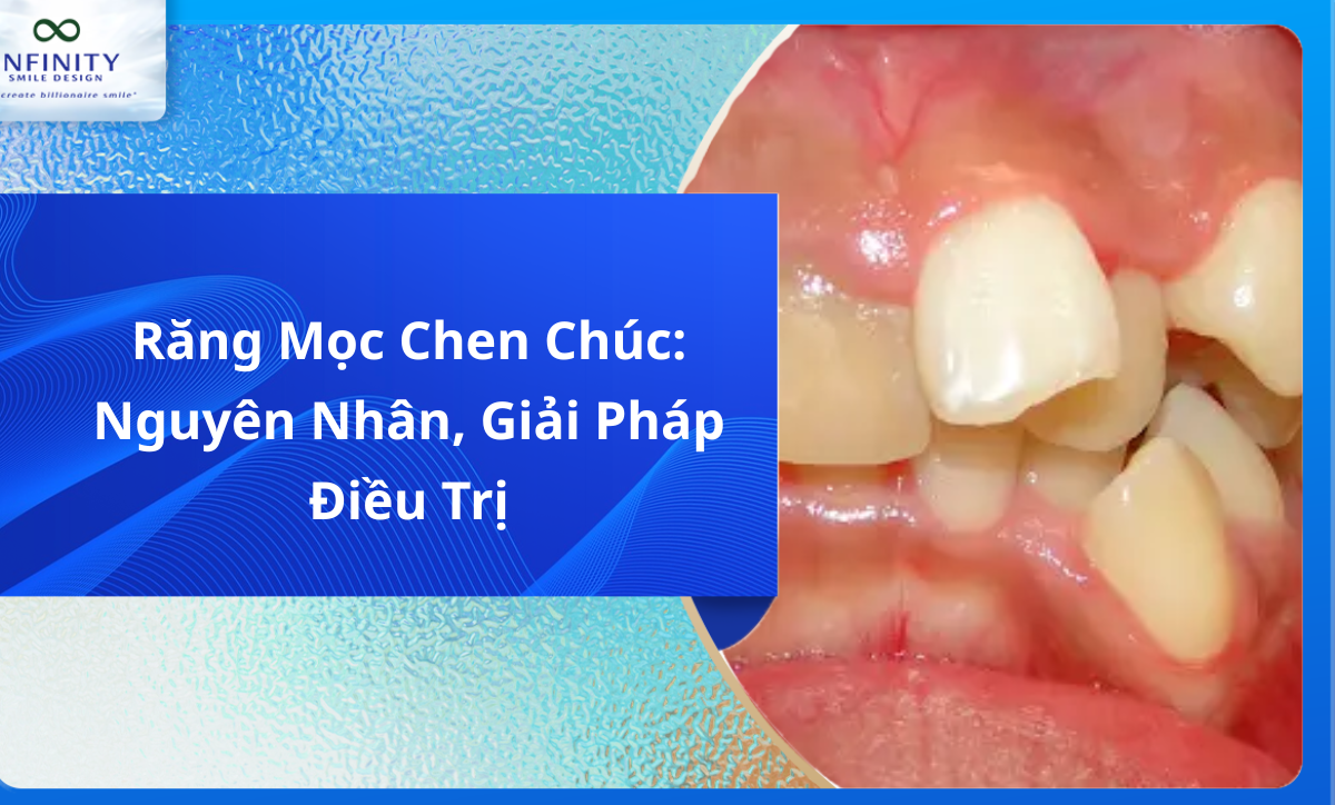 Răng Mọc Chen Chúc: Nguyên Nhân, Giải Pháp Điều Trị